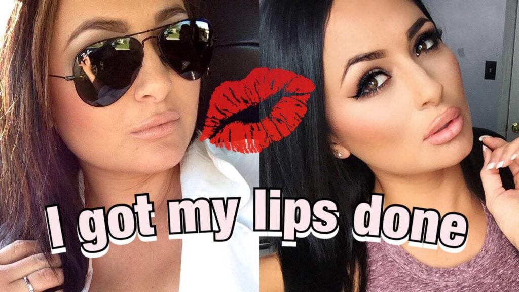Lip Fillers Before and After Pictures