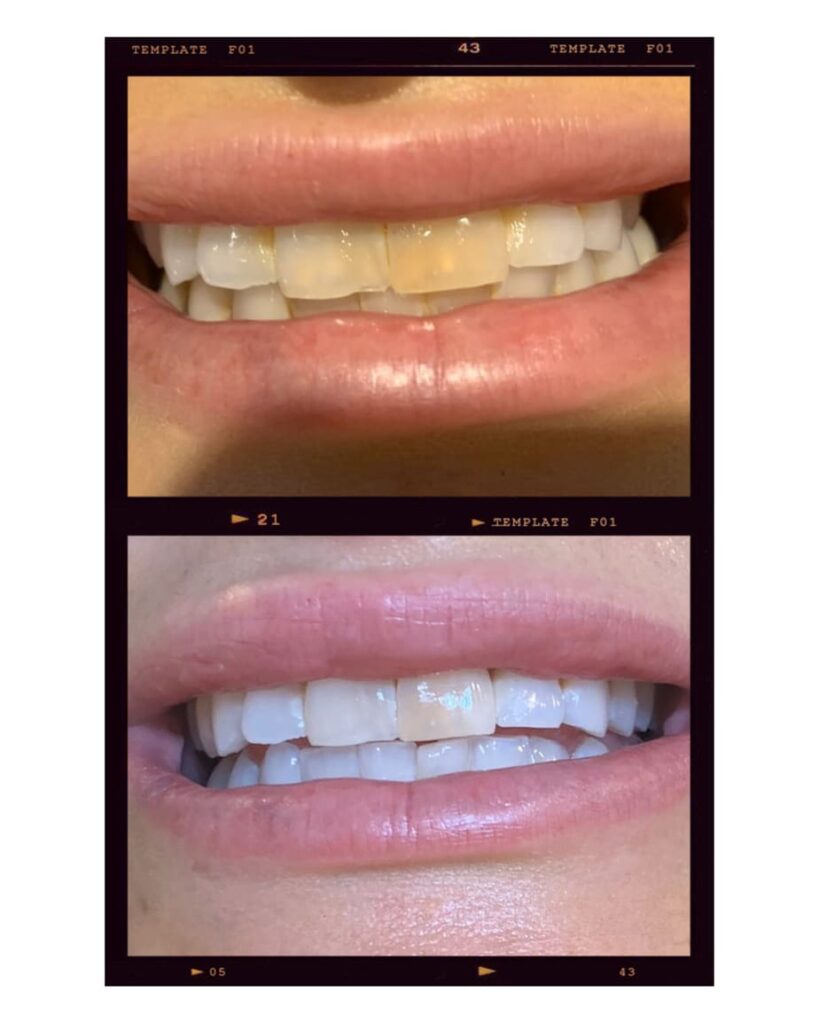 Teeth Whitening