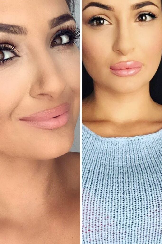 Kylie Jenner's Lips Inspired Copycat Procedures